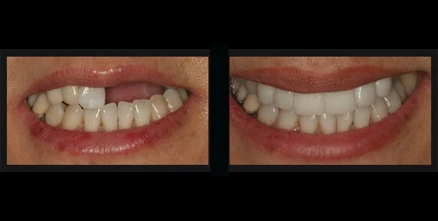 Zavedení zubního implantátu a špičková péče - Obrázek 5