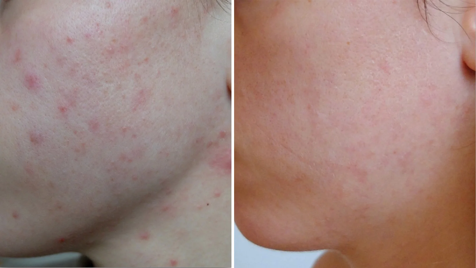 Krásná pleť: plazmové toky, ultrazvuk i mikrodermabraze - Obrázek 6