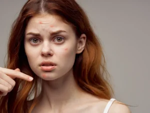 Aknózní pleť: ošetření na míru