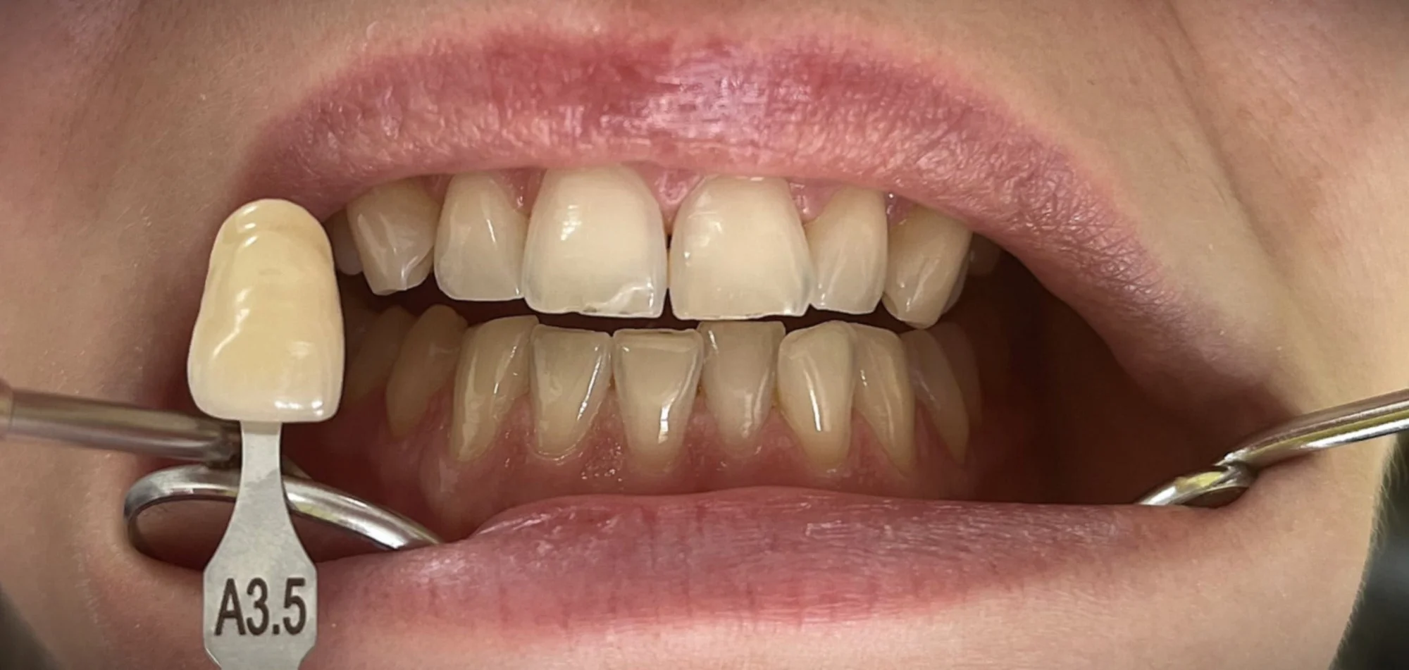 Dentální hygiena vč. pískování či domácí bělení zubů - Obrázek 7