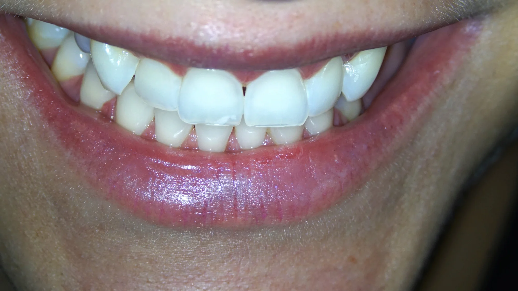 Dentální hygiena vč. pískování či domácí bělení zubů - Obrázek 8