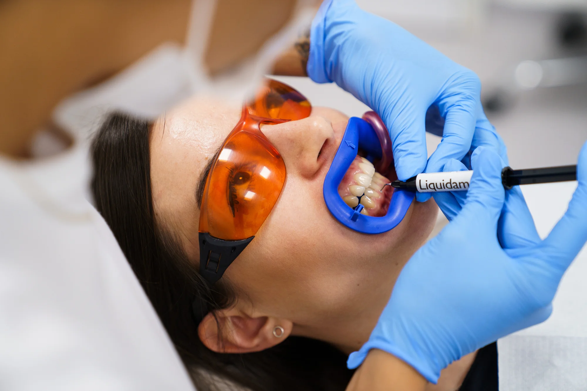 Ordinační bělení zubů LED lampou Philips Zoom - Obrázek 5