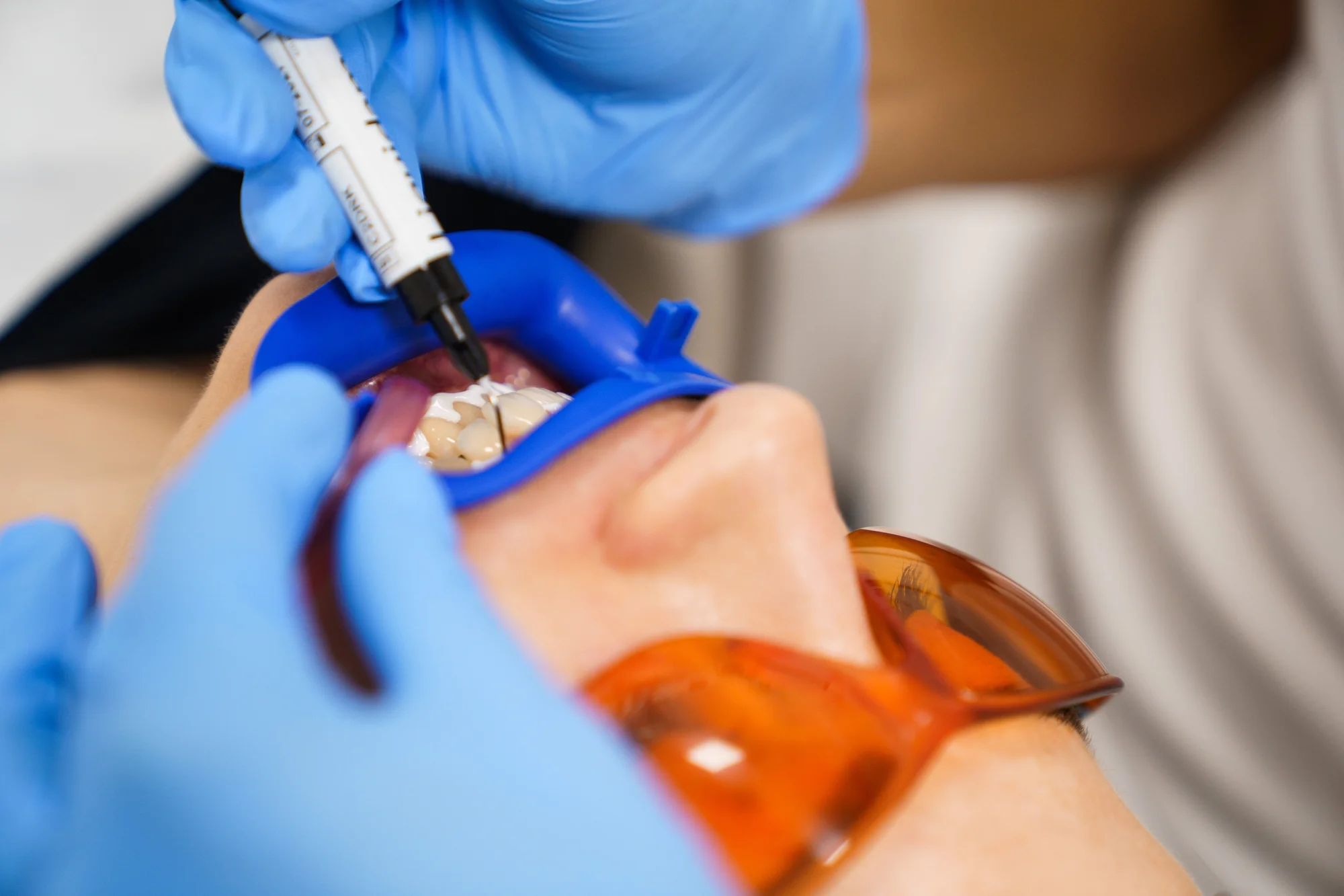 Ordinační bělení zubů LED lampou Philips Zoom - Obrázek 11