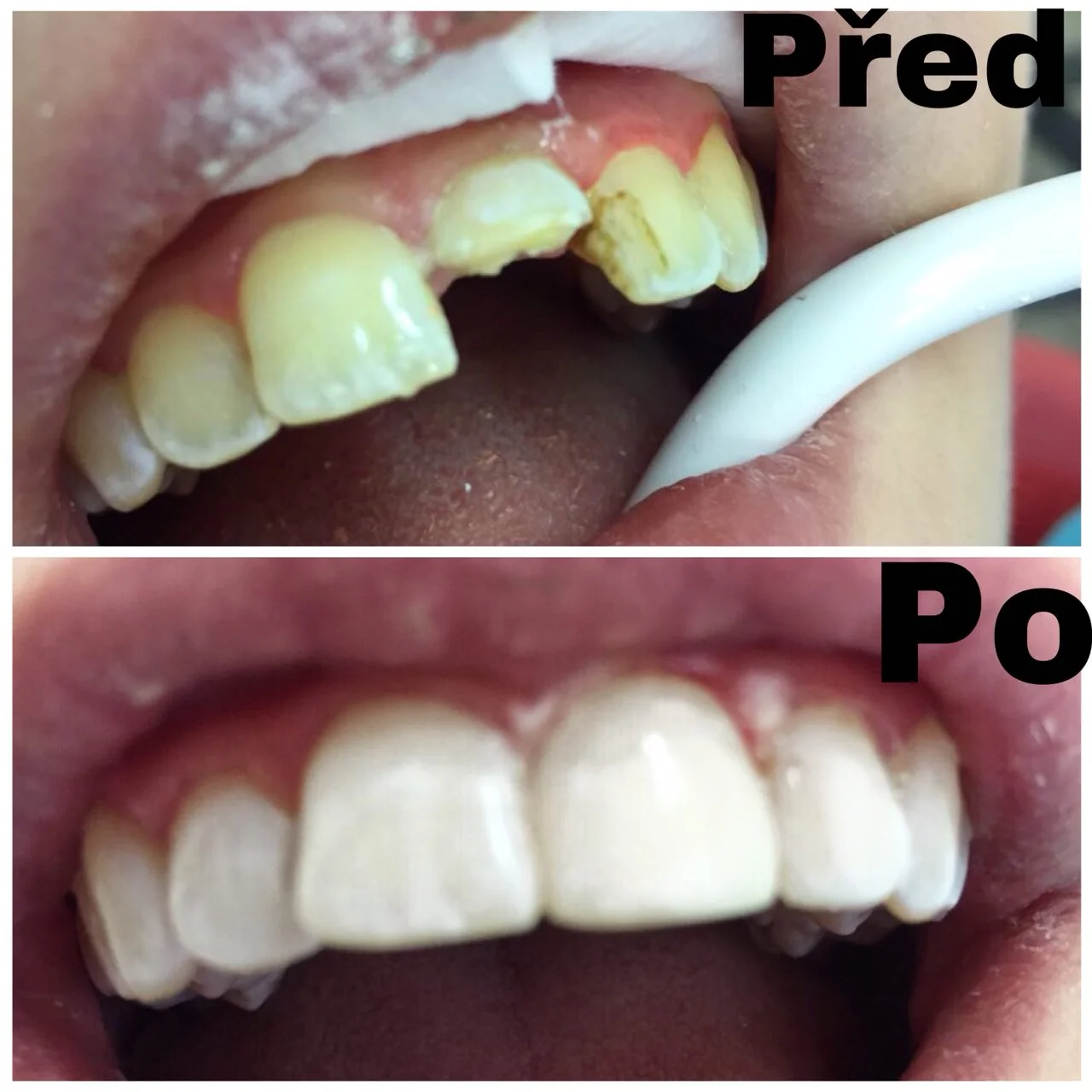 Kvalitní plomba: Obnova povrchu celého zubu - Obrázek 7