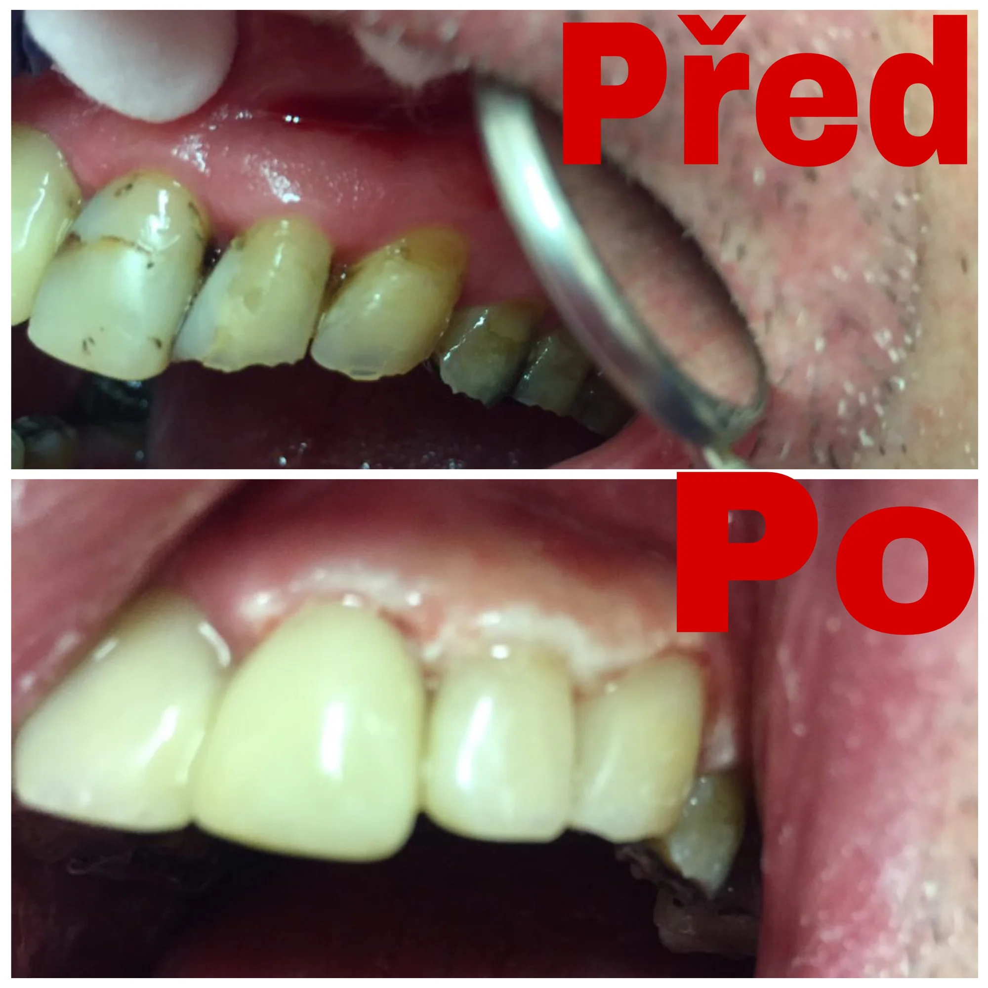 Kvalitní plomba: Obnova povrchu celého zubu - Obrázek 6