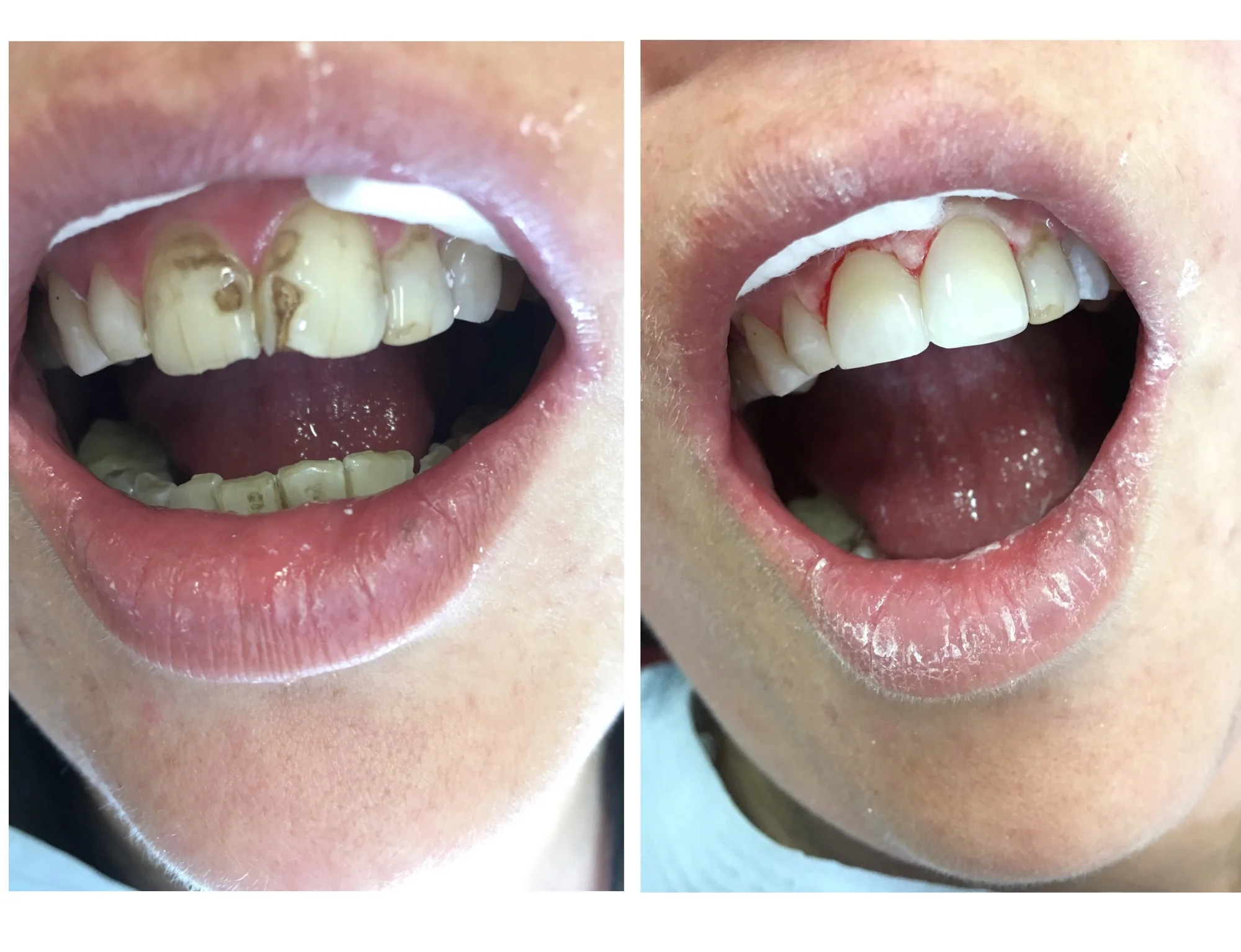 Kvalitní plomba: Obnova povrchu celého zubu - Obrázek 8