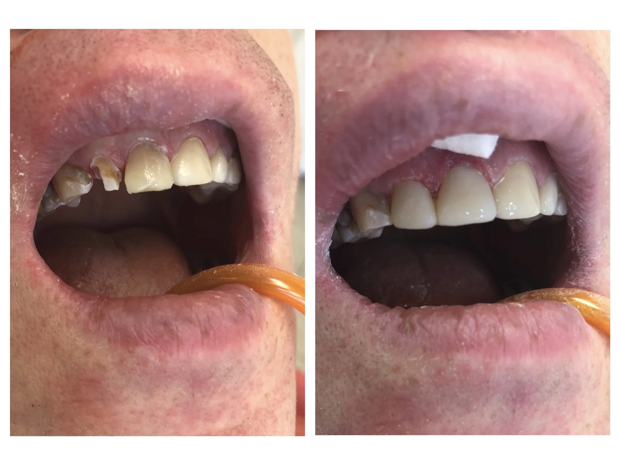 Kvalitní plomba: Obnova povrchu celého zubu - Obrázek 9