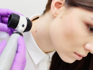 Odstranění znamének, pih či bradavic K-laserem