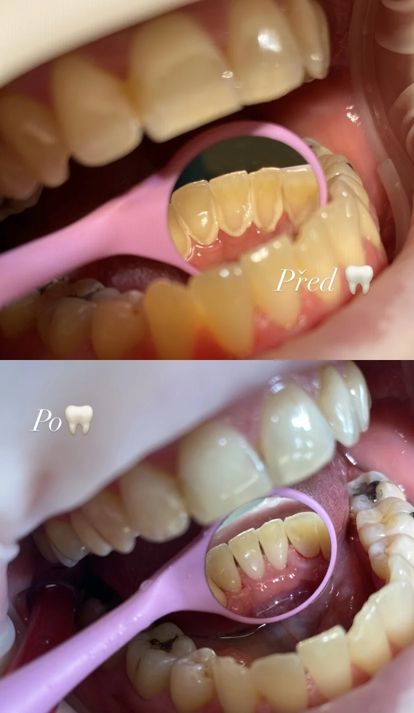 Dentální hygiena pro zářivý a zdravý úsměv - Obrázek 9