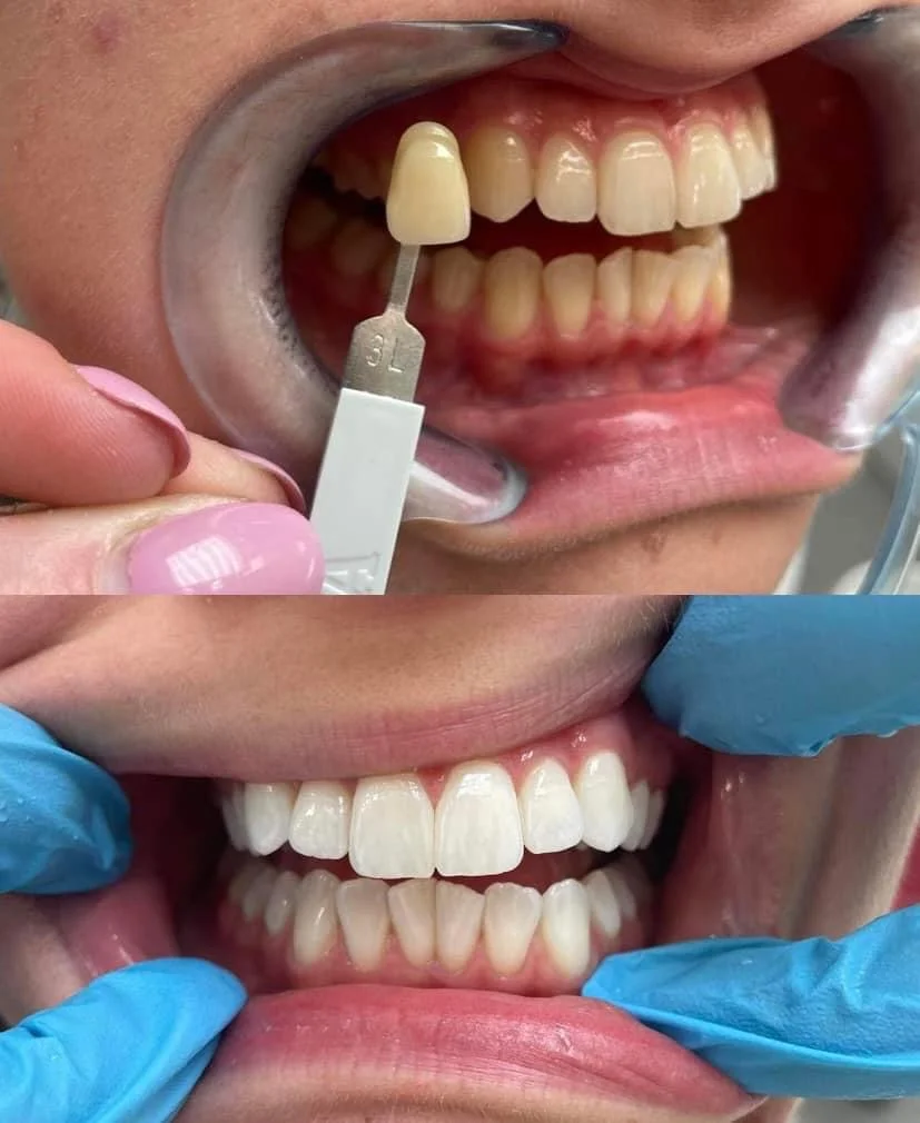 Dentální hygiena pro zářivý a zdravý úsměv - Obrázek 11