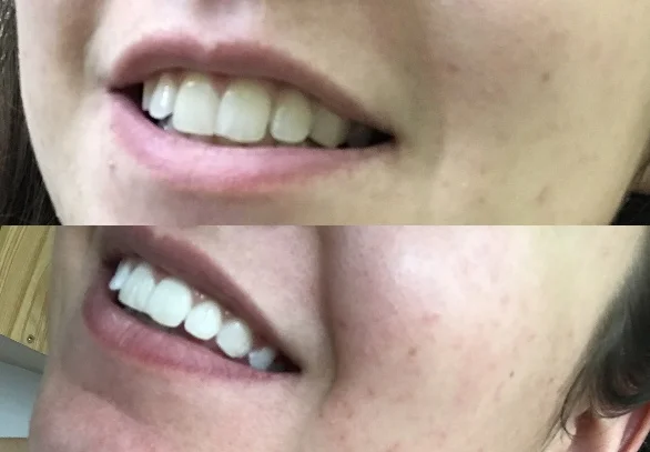 Zářivý úsměv: ordinační bělení zubů - Obrázek 9