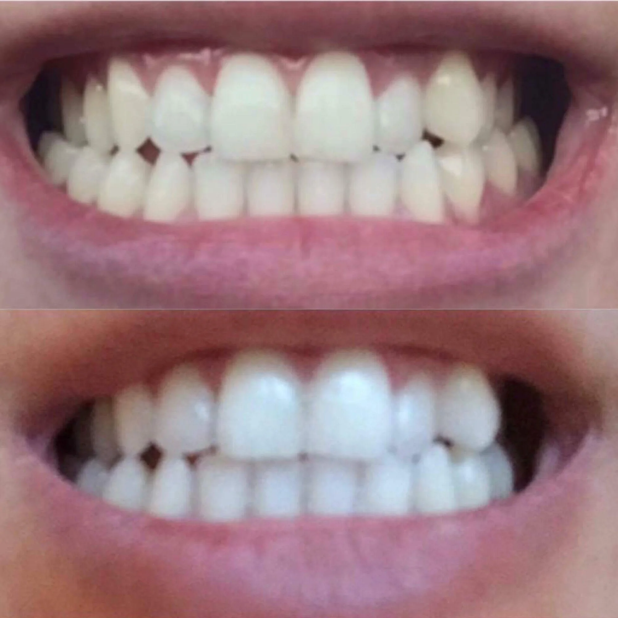 Zářivý úsměv: ordinační bělení zubů - Obrázek 5