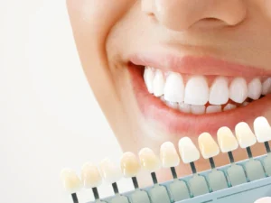 Bělení zubů včetně komplexní dentální hygieny na Vinohradech