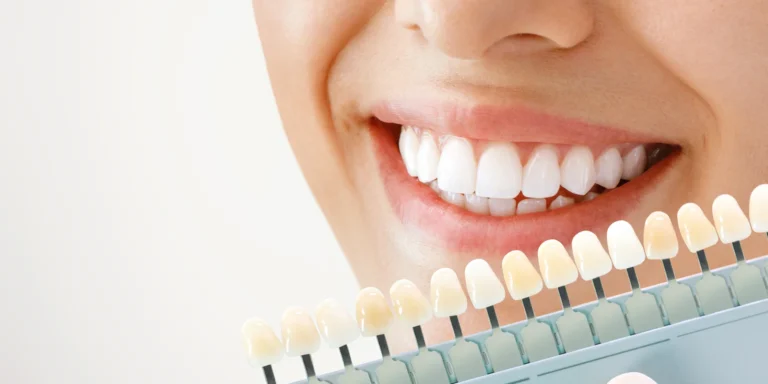 Bělení zubů včetně komplexní dentální hygieny na Vinohradech