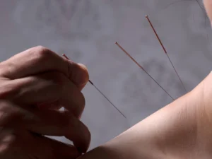 90minutová akupunktura s hloubkovou zdravotní masáží